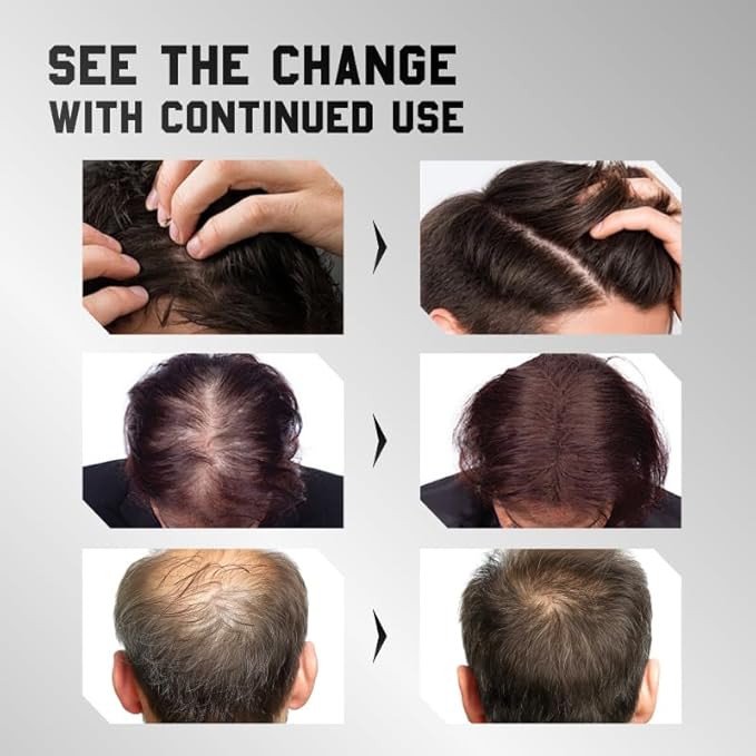 Hair Growth Spray, Hair Density Spray for Women & Men, Anti-Thinning Treatment for Thicker Fuller Hair, with Polyamino Sugar Condensate & Ginseng, Natural Hair Regrowth Serum for All Hair Types