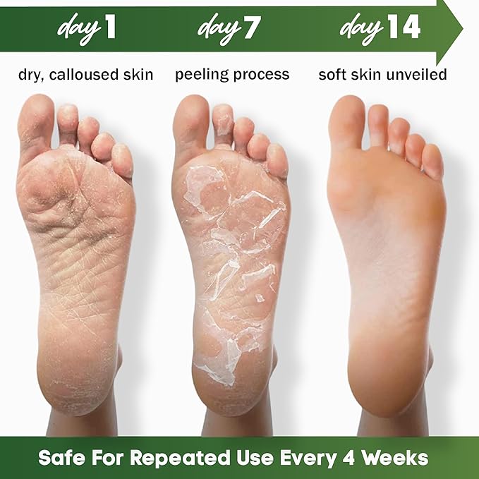 Foot Peeling Mask – Lavender Exfoliating Treatment Booties for Callus Removal & Renewal of Dry, Cracked Feet – Dermatologist-Inspired Moisturizing Spa Therapy for Men & Women (Tea Tree 2 Pairs)