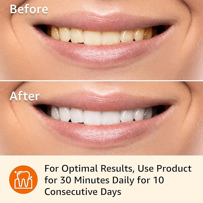 Amazon Basics 10 Day Teeth Whitening Strips Kit, 10 Treatments, 1-Pack (Previously Solimo)