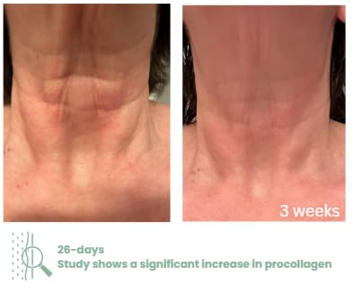 NECK+ Regenerative Cream, Collagen Boosting Neck Cream, Firms,Tightens, Lifts, with Peptides & Growth Factor Complex, Gentle on Skin,Clinically Tested, 1.7 fl oz (Full-Size)