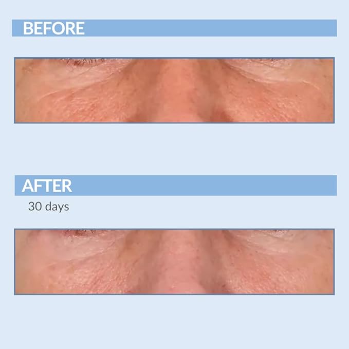 Serious Skincare Vitamin A Force XR Retinol Face Serum Concentrate, Micro Exfoliate & Resurface for Radiant Skin, for Lines, Wrinkles, Pore Minimizer, Anti-Aging 1 Oz. (Pack of 2)