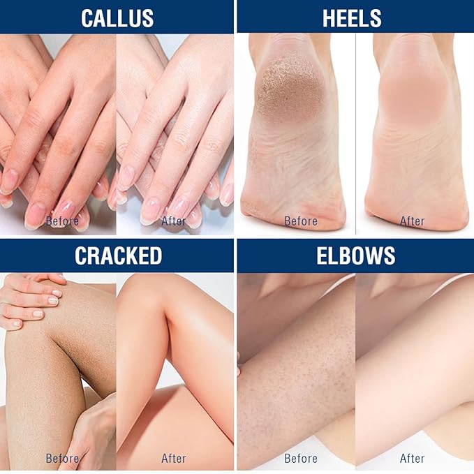 OUKEYA Urea Cream 42% plus Salicylic Acid 2% Net 350g for Dry Cracked Feet, Heels, Knees, Elbows, Hands Repair Treatment.Moisturizes and Removes Corns,Calluses,Dead Skin,and Softens Toenails