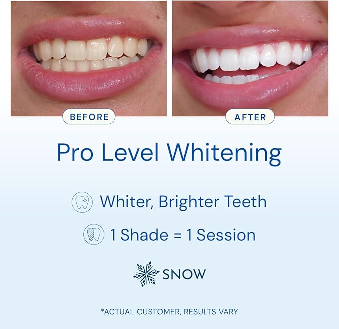 Snow Teeth Whitening Kit - Snow Teeth Whitening Serum and LED Mouthpiece Whitener, Formulated with Hydroxyapatite, Good for 6 Months - Wireless Kit with 3 Wands