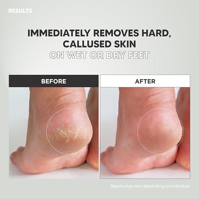 Wide Emery Foot File(Pink), Double-Sided Pedicure Tool, Colossal Professional Foot Scrubber for Men & Women, Effective for Cracked Heel, Callus Remover