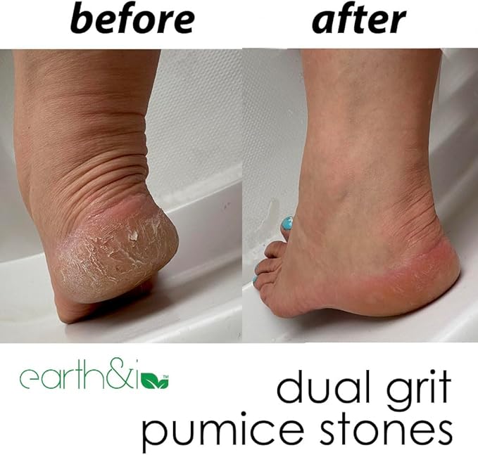 Earth & I Foot Stone Pumice 2 Grits (6 pcs) Heel Exfoliator for Feet, Pumice Stone Feet, Heel Scrubber, Pedicure Callus Remover, Pumice Sponge for feet, feet Scrubber, feet Dead Skin Remover