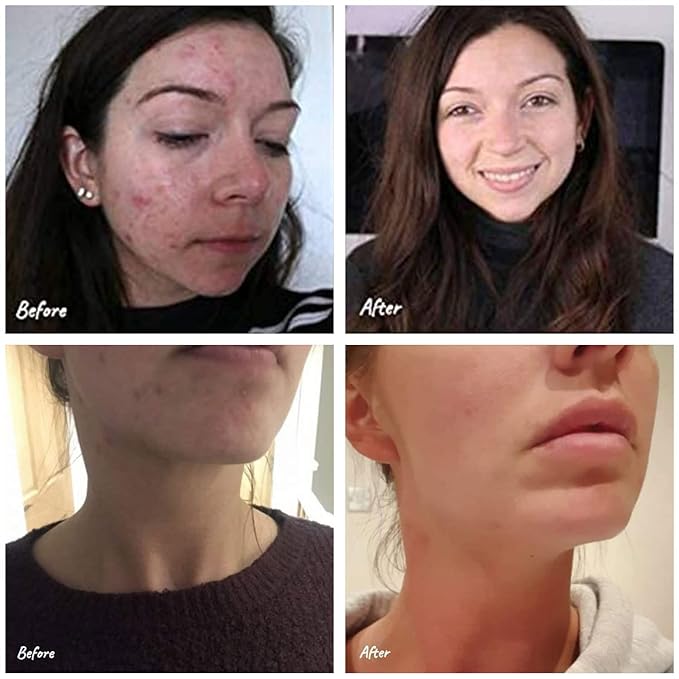 Science of Skin Rescue No. One For Spot, Blemish and Acne Scars
