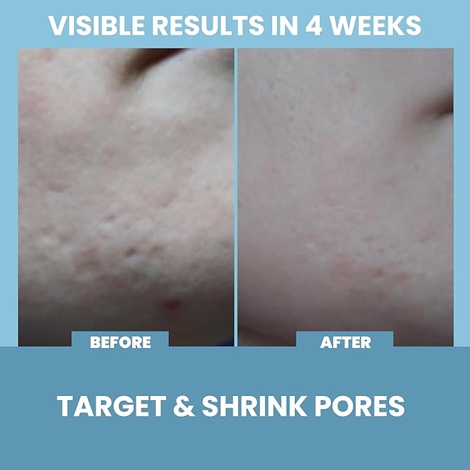 Eva Naturals Niacinamide 5% Serum for Face – B3 Pore Minimizer, Acne Treatment & Dark Spot Corrector with Hyaluronic Acid, Vitamin E, Aloe & Neem – Anti-Aging, Non-Greasy, Hydrating, 2oz