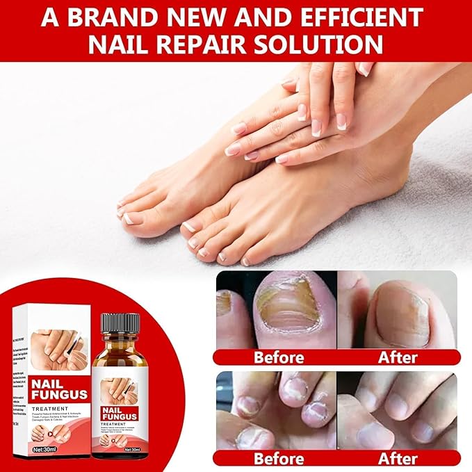 Toenail Fungus Treatment Extra Strength, Nail Fungus Treatment for Toenail, Natural Plant Extracts Toe Nail Fungus Treatments for Athletes Foot