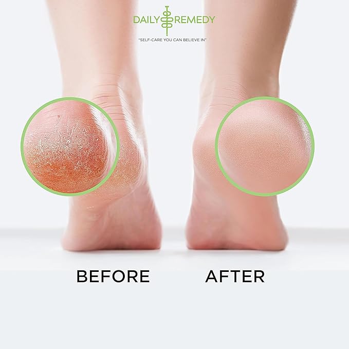 Tea Tree Oil Foot Soak with Epsom Salt - Made in USA - 16 Ounces