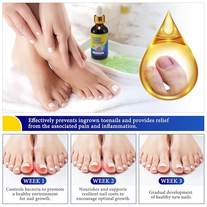 Nail Removal Kit,Toenail Drops,Softens Nails,Nail Care Tool Set,Ingrown Toenail Corrector,Corrector Patch,Nail File,60ml