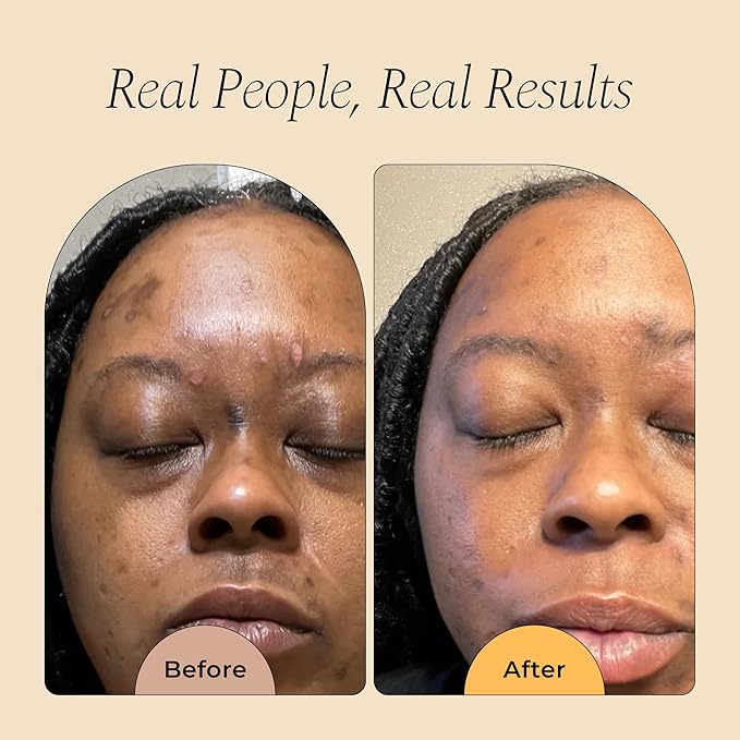 Glo Melanin Dark Spot Remover for Face - Dark Spot Corrector Serum with Vitamin C - Reduces Discoloration and Hyperpigmentation