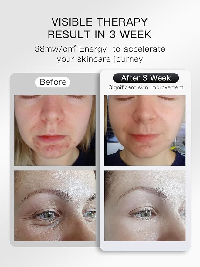 Red Light Therapy for Face, LED Face Mask Infrared Light Anti-Aging, 3 Modes for Blue & Yellow LED for Home, Yoga, Skincare, 2500mAh Rechargeable Remote Control, Adjustable Straps, Silicone