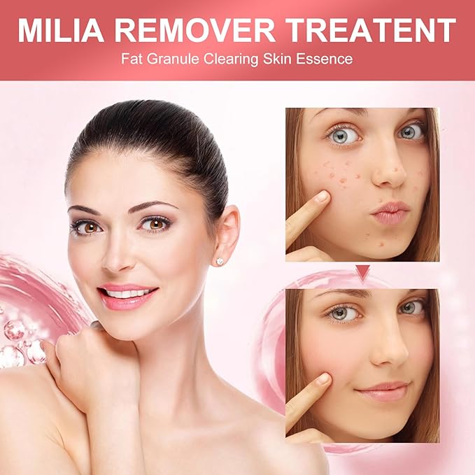 Milia Remover Serum for Eye & Face,Milia Spot Treatment with Salicylic Acid,Milia Acne Serum