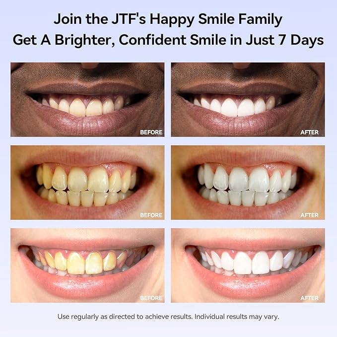JTF Teeth Whitening Gel Kit: 35% Carbamide Peroxide, 5Pcs Teeth Whitener Gels and 1 Remineralization Gel to Remove Stains from Coffee Food and Smoking, Enamel Safe and No Sensitivity, Mint