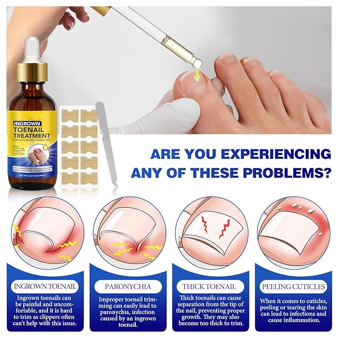 Nail Removal Kit,Toenail Drops,Softens Nails,Nail Care Tool Set,Ingrown Toenail Corrector,Corrector Patch,Nail File,60ml