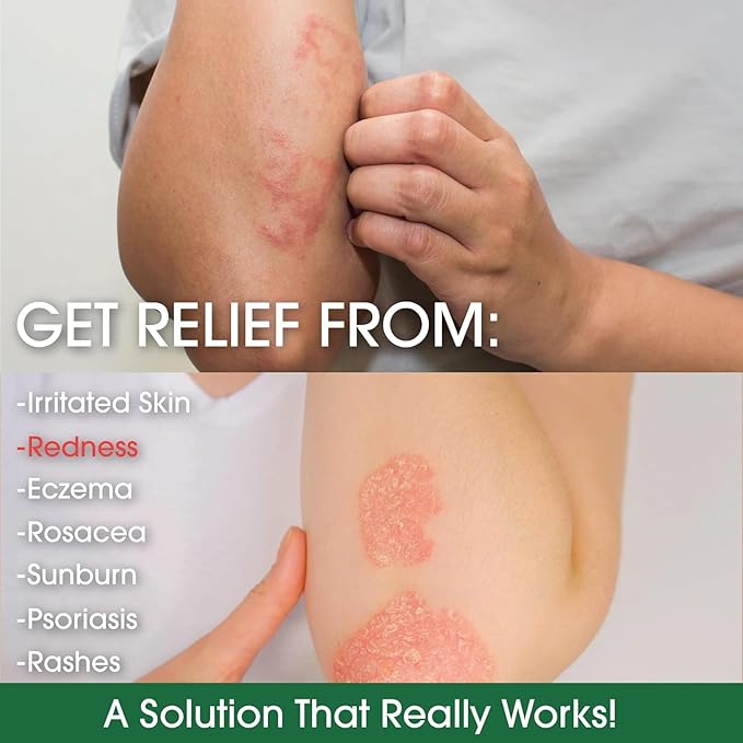 Manuka Honey Eczema Cream Moisturizing Lotion Fragrance Free For Psoriasis Relief - Itchy, Dry Skin Rash Ointment - Skin Soothing Moisturizer - Body & Face Cream - Kids & Adults 16oz