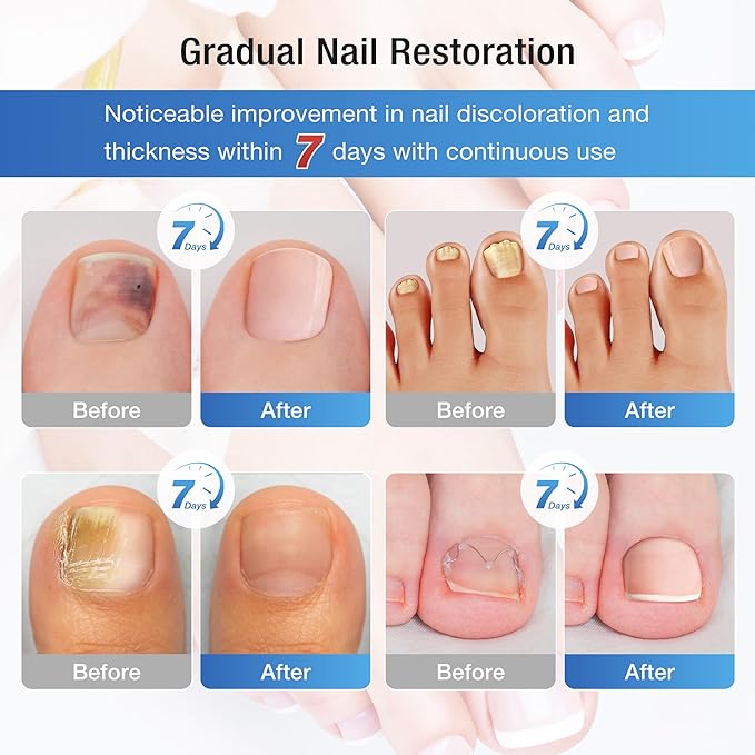 Toenail Fungus Treatment Extra Strength – 30mL Liquid Solution and 20 Fungal Nail Patches for Thick, Brittle or Discolored Nails – Gentle Repair for Damaged Toenails and Fingers–Dual-Action Treatment