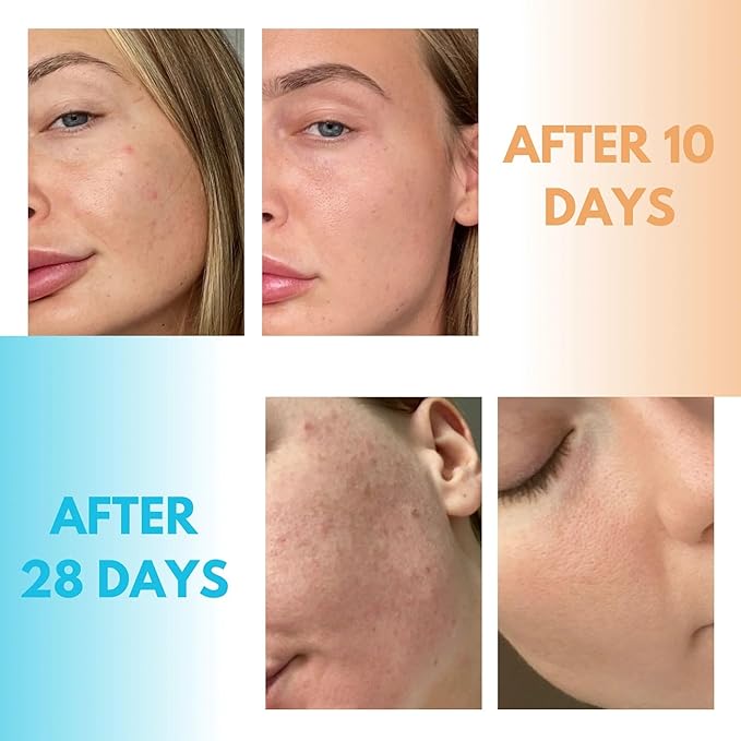 Kanzen Skincare Derma Acne Duo – Complete Skincare Set with Cleansing Water & Pore Purifier for Clearer Skin