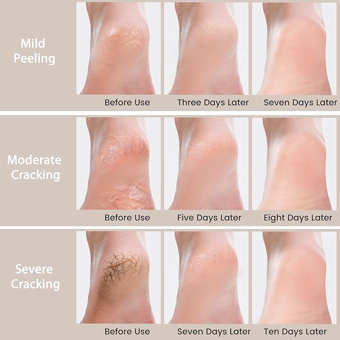 3 Packs Urea Cream 40 Percent - Foot & Hand Cream, for Dry, Cracked Heels, Feet, Knees, Elbows, and Hands, Callus Remover, Maximum Strength Urea Lotion for Softening and Moisturizing