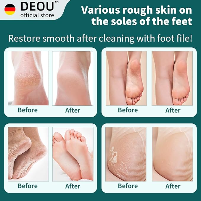 DEOU Metal Foot File SStainless Dead Skin Callus Remover for Dead Skin Professional Secure Foot Scrubber Heel Scraper Cracked Heels Repair Pedicure Tools for feet