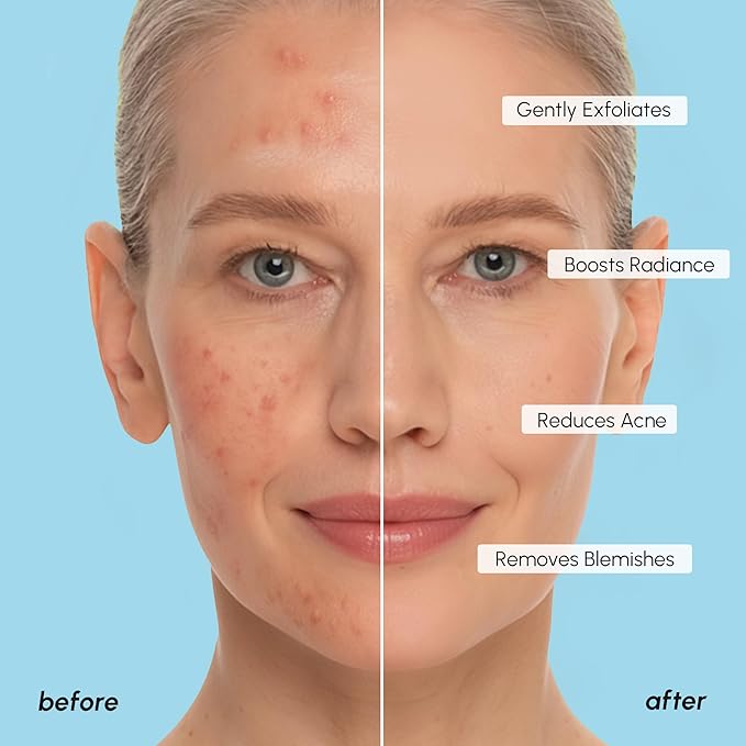 MAREE Glycolic Toner Pads – 200 Toner Pads for Face Cleansing – Facial Exfoliating Pad with Tea Tree Oil, Salicylic Acid & Vitamins E, B3, B5 – Acne Clearing, Skin Pore Resurfacing & Radiance Device