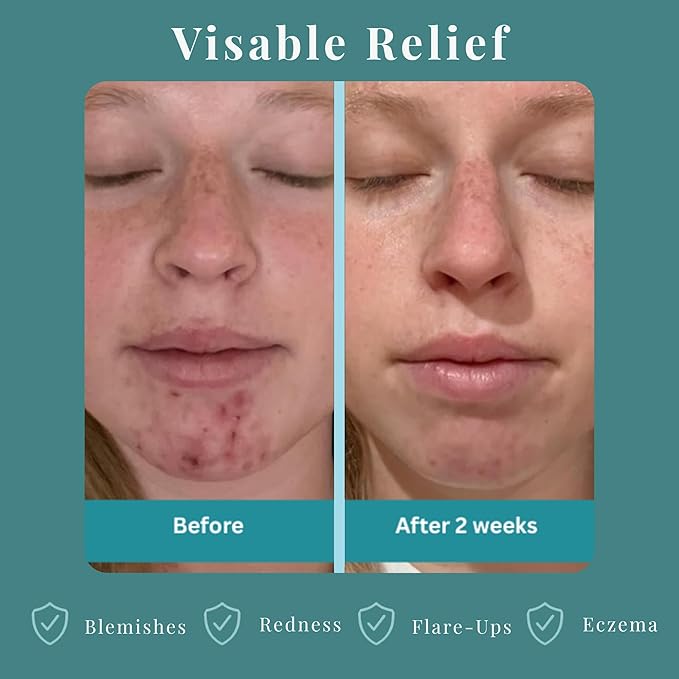 JusSpray™ Hypochlorous Acid (HOCl) Spray – Doctor Approved Skin Defense Mist 4 oz – Face & Body Toner for Sensitive, Acne & Eczema-Prone Skin, Redness Relief & Piercing Aftercare (3-Pack)