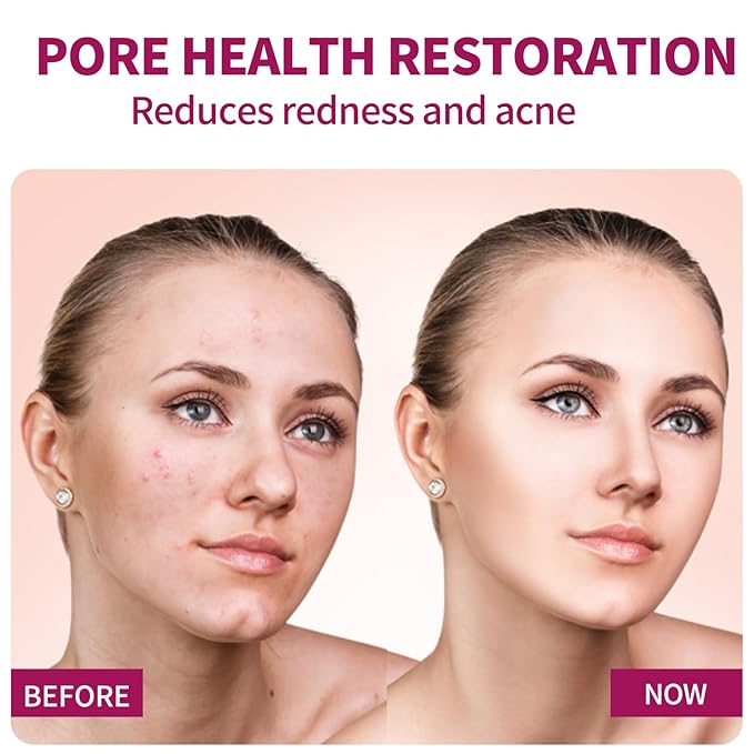 Azelaic Acid for Face Balance Skin Tone & Cleanse Pores, Azelaic Acid Serum-Relieve Acne, Blackhead & Redness,Premium Skin Care,20g(1 Pcs) (2PCS, Gram, 20)