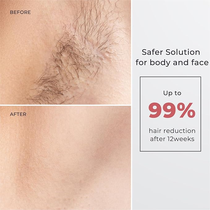 Laser Hair Removal for Women and Men, IPL with Ice-Cooling System for Nearly Painless And Long-Lasting Result At-Home Permanent Hair Removal Device 999999 Flashes for Whole Body Use
