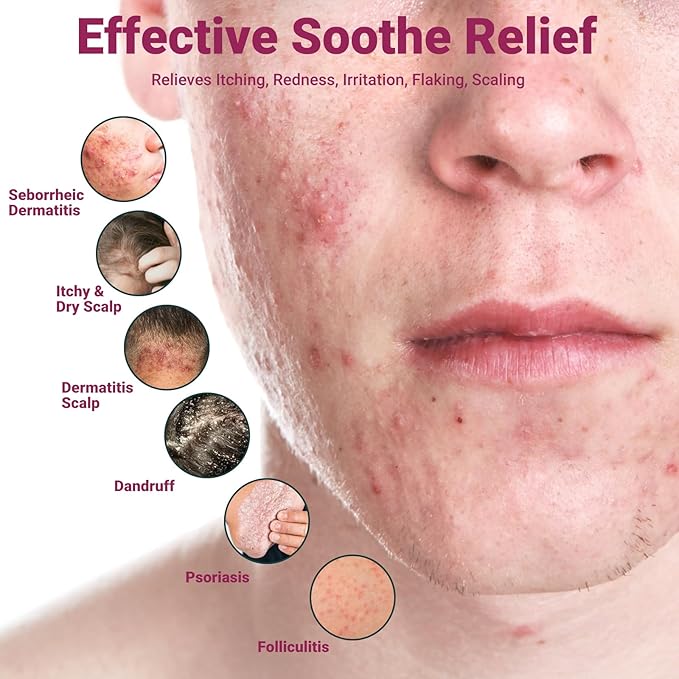 ishancare Seborrheic Dermatitis Cream, Maximum Strength Treatment for Psoriasis, Folliculitis, Dermatitis, Dandruff, Fast Relief for Itching, Redness, Irritation, Scaling, 3.53 Oz