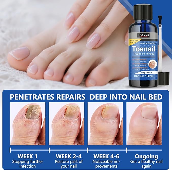 Toenail Fungus Treatment Extra Strength, Nail Fungus Treatment with 25% Undecylenic Acid, Upgraded Fungal Nail Repair for Yellow, Discolored, Thick and Ingrown Nails, 2 Bottles
