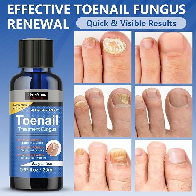 Toenail Fungus Treatment Extra Strength, Nail Fungus Treatment with 25% Undecylenic Acid, Upgraded Fungal Nail Repair for Yellow, Discolored, Thick and Ingrown Nails, 2 Bottles
