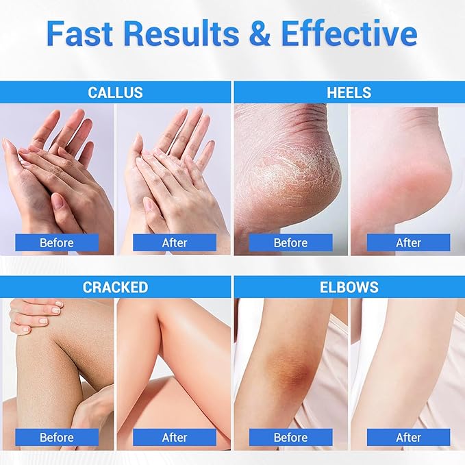 Urea Cream 40 Percent for Feet Maximum Strength, Foot Cream for Dry Cracked Heels Feet Knees Elbows Hands, Urea 40% Cream for Deep Moisturizes, Callus Remover, Heel Crack Repair