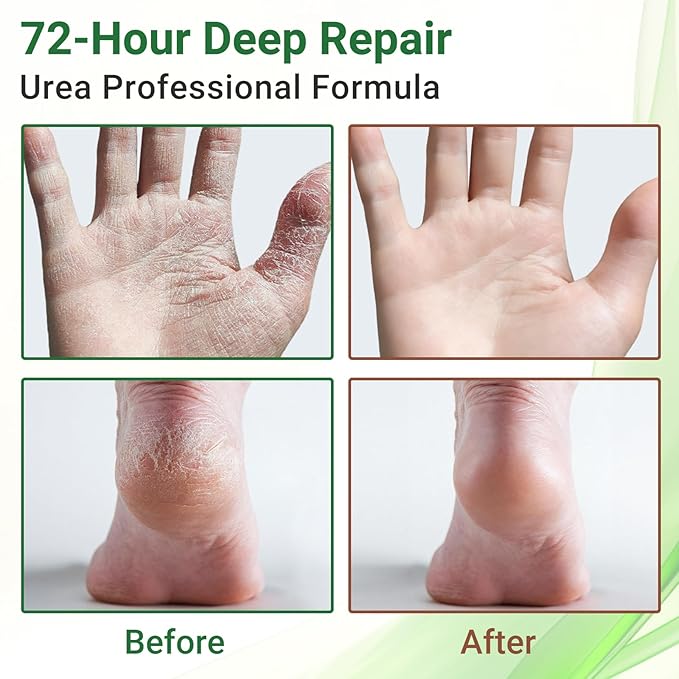 ishancare Moisturizing & Repair Cream with Urea – Intensive Treatment for Extremely Dry, Cracked Skin – Soothes Rough Hands & Heels – 200g Jar