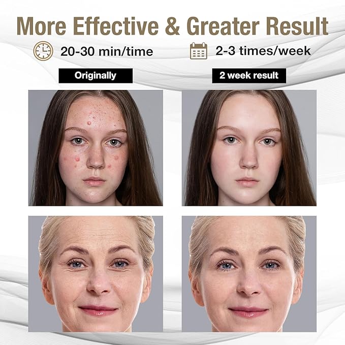 Pro-Grade FSA LED Light Therapy Facial Mask- HSA Salon Treatment for Acne, Wrinkles & Redness at Home