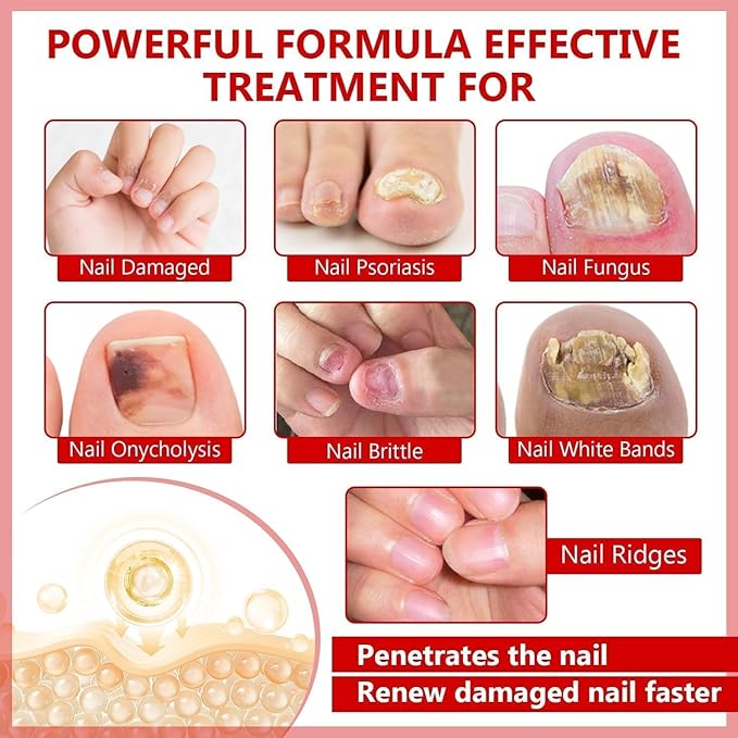 Toenail Fungus Treatment Extra Strength, Nail Fungus Treatment for Toenail, Natural Plant Extracts Toe Nail Fungus Treatments for Athletes Foot