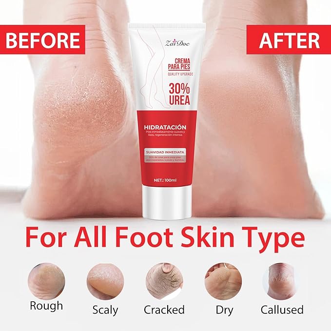 Urea Cream 30 Percent for Feet 3.38 oz, Foot Cream and Hand Cream Maximum Strength with Hyaluronic Acid, Aloe Vera for Deep Moisturizes, Callus Remover