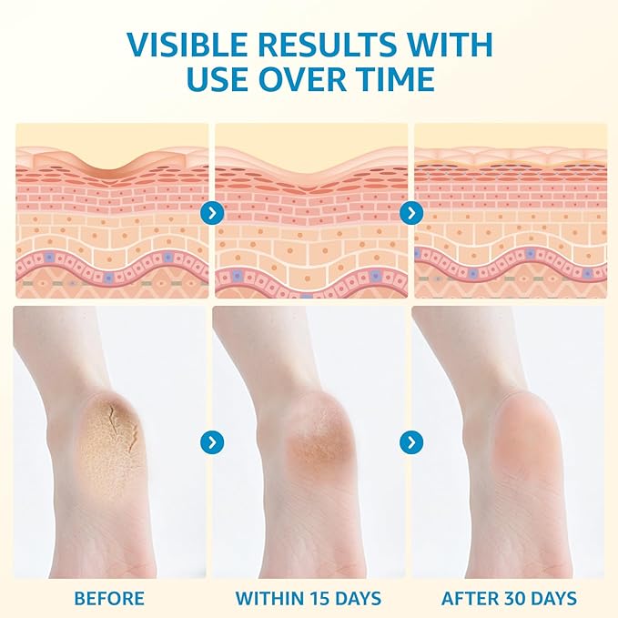 40% Urea Cream for Feet – Foot Cream with 2% Salicylic Acid for Dry Cracked Heels and Feet, Urea 40% Foot Lotion, Formulated with Shea Butter, Tea Tree Oil for Deep Moisturizing(5.29oz)