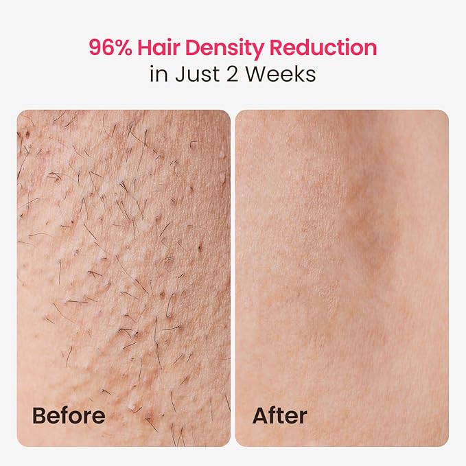 Laser Hair Removal, 25J Energy Triple-Pulse IPL Laser Hair Removal for Women, 12 cm² Comfort Sapphire 37 °F Ice-Cooling Contact, Hair Removal Device for Armpits Legs Arms Bikini Line