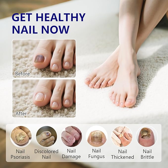 iKeener Toe Nail Fungus Treatment Pen - 25% Undecylenic Acid, Tea Tree Oil Extra Strength for Toenails and Fingernails, 0.4 Fl Oz (Pack of 4)