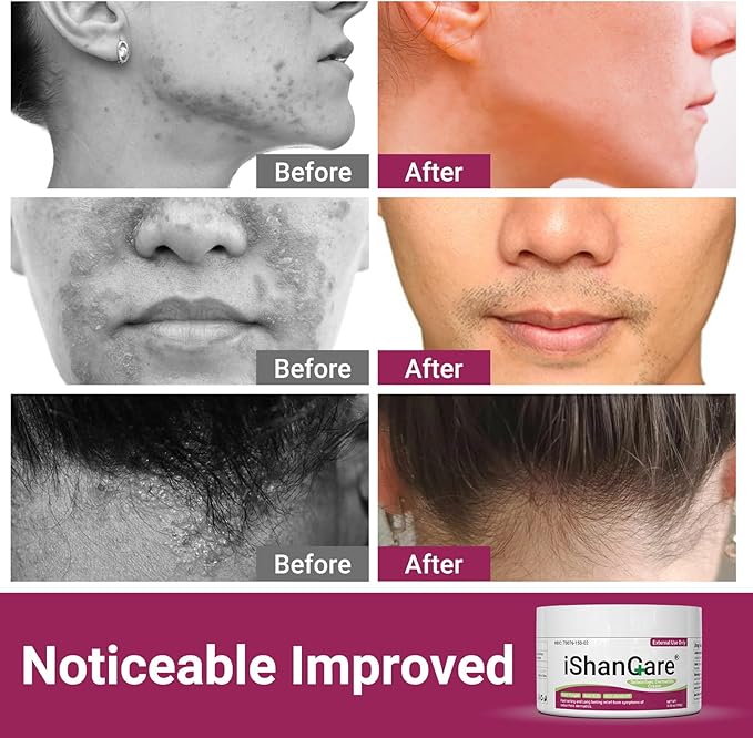 ishancare Seborrheic Dermatitis Cream, Maximum Strength Treatment for Psoriasis, Folliculitis, Dermatitis, Dandruff, Fast Relief for Itching, Redness, Irritation, Scaling, 3.53 Oz