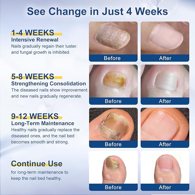 Toenail Fungi Treatment Extra Strength - Fungi Nail Pen, Ingrown toenail treatment, nail repair, Fungus nail treatment, yellow toenail, Damaged Nails foot fungus treatment extra strength