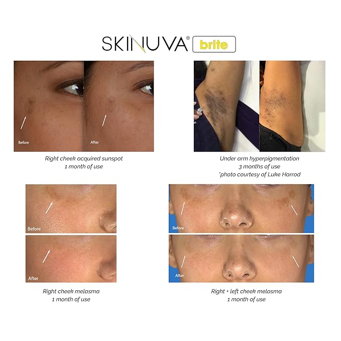 Skinuva® Brite Dark Spot Treatment – Tone-Enhancing Cream Formulated with Growth Factors, Vitamin C, and Niacinamide For All Skin Types