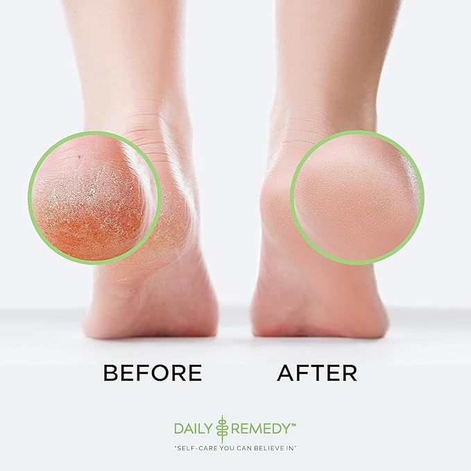 EXTRA STRENGTH Tea Tree Oil Foot Soak with Epsom Salt - Made in USA - for Toenails, Athlete's Foot, Itchy Feet, Stubborn Smelly Foot Odor, Pedicure, Foot Calluses & Soothes Sore Tired Achy Feet-2 Pack