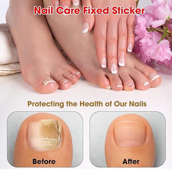Fungal Nail Patches, Toenail Treatment Extra Strength Kit for Daily Care - Step 4 Nail Repair for Restores Damaged Nails and Appearance of Discolored