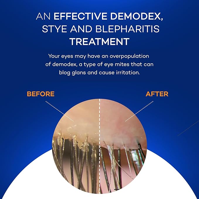 Zocuwipe Eyelid Wipes with Natural Okra Complex - Eyelid Cleanser and Moisturizer Pads for Irritated, Red Eyes from Dry Eye, Blepharitis 30ct