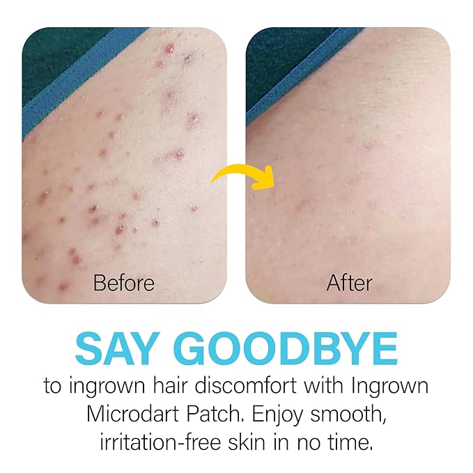 Ingrown Hair Patch With Microdart: Ingrown Hair Treatment - Fast and Effectively Clean Up Ingrown Hair Bumps for Facial, Beard, Armpits, Bikini Area for Men and Women - 9 Pack