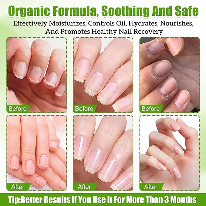 3PCS Orvalle Nail Fungus Pen,Nail Growth Treatment Repair Serum Twist Pen Activator,Nail Revitalizing Serum to Help Repair & Strengthen Nails,Nail Care Pen for Damaged Nails