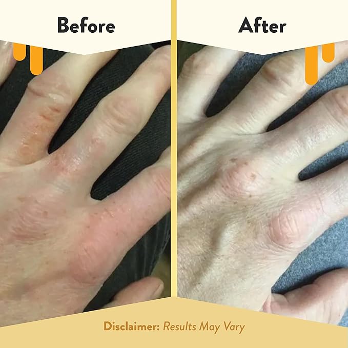 ECZEMA HONEY Oatmeal Hand Cream - Natural Hand & Body Lotion for Eczema Rash Relief - Eczema Cream for Dry, Itchy, Sensitive, & Irritable Skin (2 Oz)