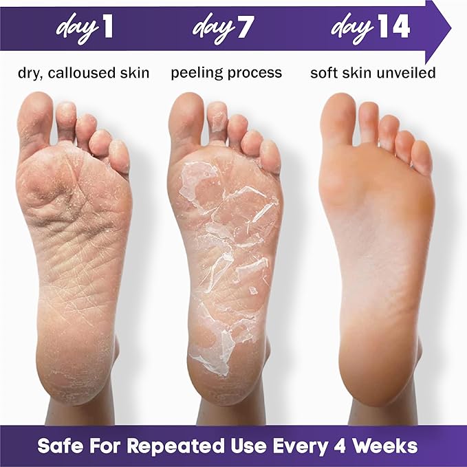 Foot Peeling Mask – Lavender Exfoliating Treatment Booties for Callus Removal & Renewal of Dry, Cracked Feet – Dermatologist-Inspired Moisturizing Spa Therapy for Men & Women (Lavender 2 Pairs)