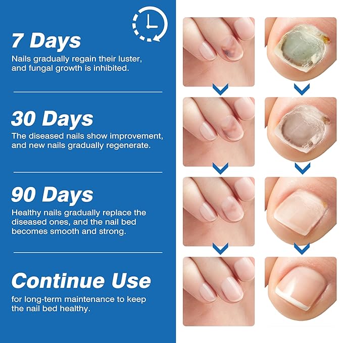 Toenail Fungi Treatment Extra Strength - Fungi Nail Pen Antifungal Repair for Damaged Nails, Fast-Acting Solution for Toe & Fingernail Fungi, Ideal for Nail Health Concerns Athletes 5ml/0.18FLOZ 3Pcs